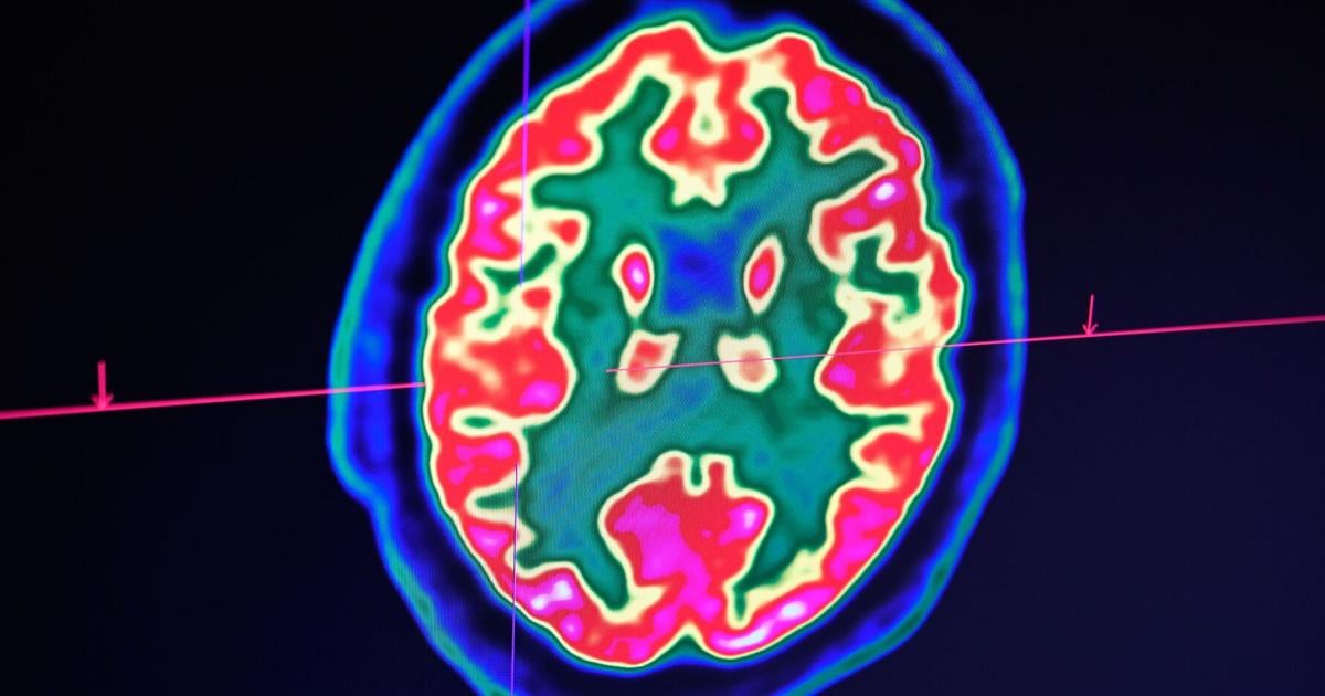 Boston scientists create AI model to 'catch Alzheimer's disease early' – The Union Leader